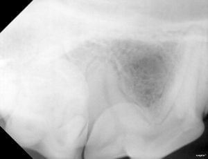 Upper 4th premolar dental x-ray