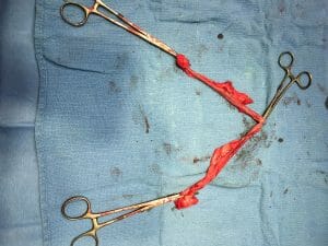 Normal dog uterus after spay